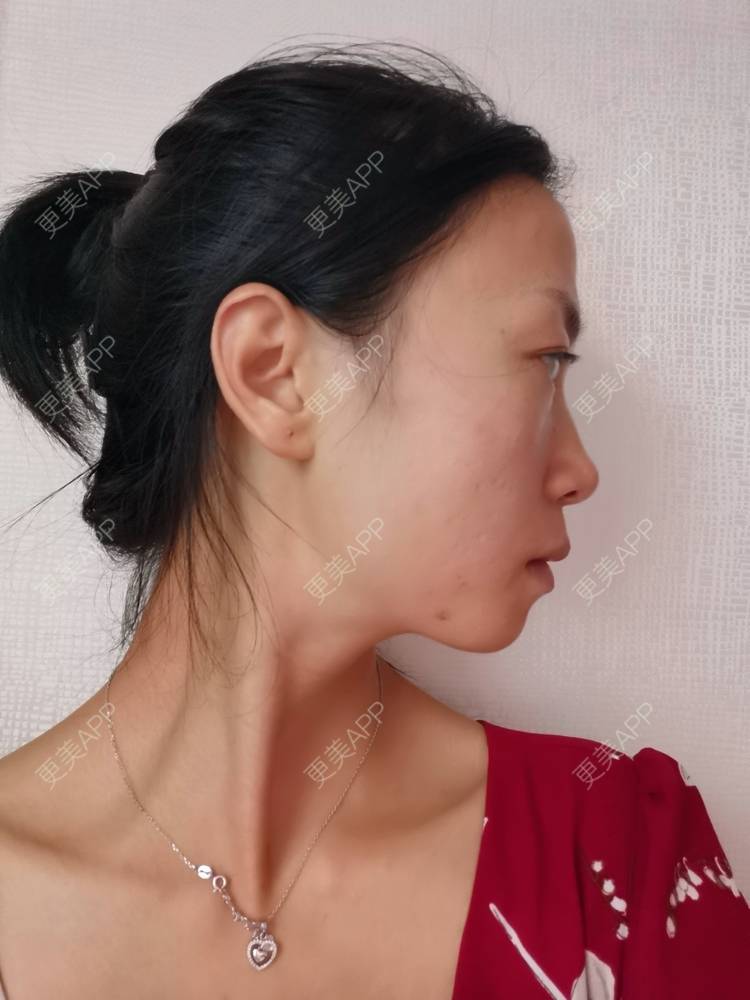 更美 - 更美用户y1zfD0qgXq的玻尿酸苹果肌经验 | 玻尿酸苹果肌 | 抚州