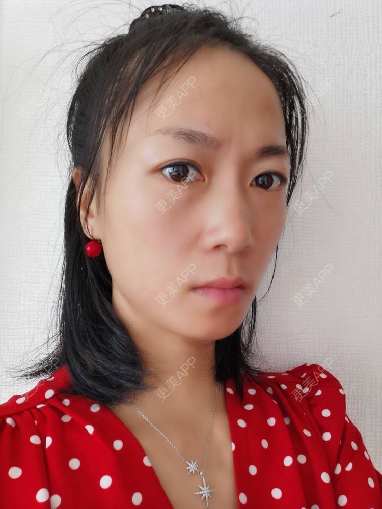 更美 - 更美用户y1zfD0qgXq的玻尿酸苹果肌经验 | 玻尿酸苹果肌 | 抚州