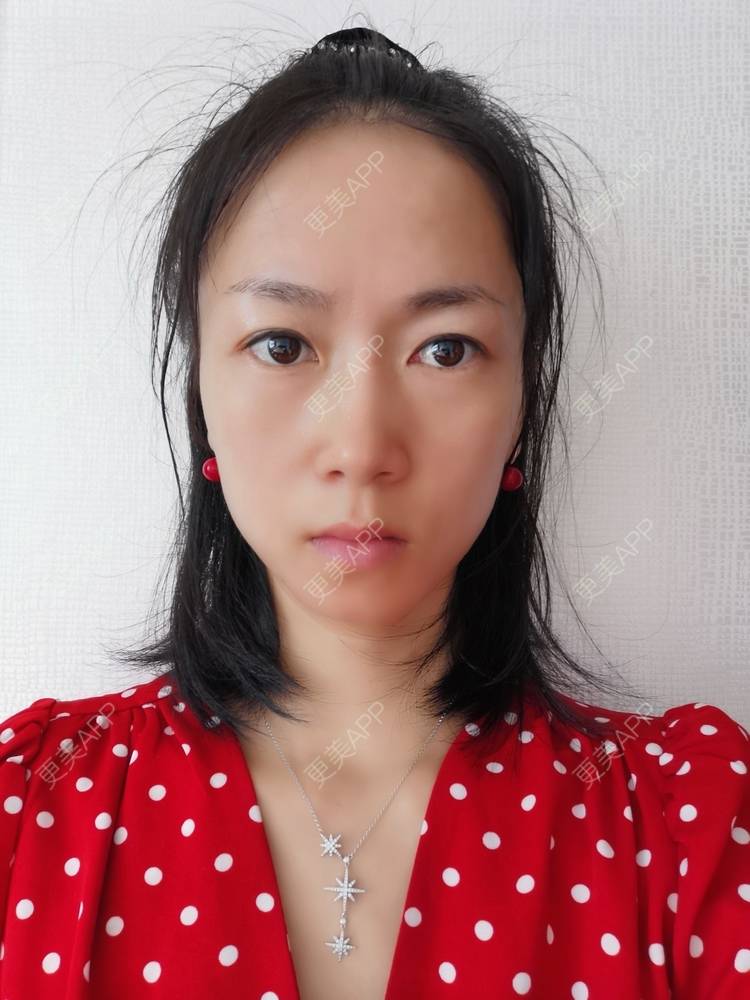 更美 - 更美用户y1zfD0qgXq的玻尿酸苹果肌经验 | 玻尿酸苹果肌 | 抚州