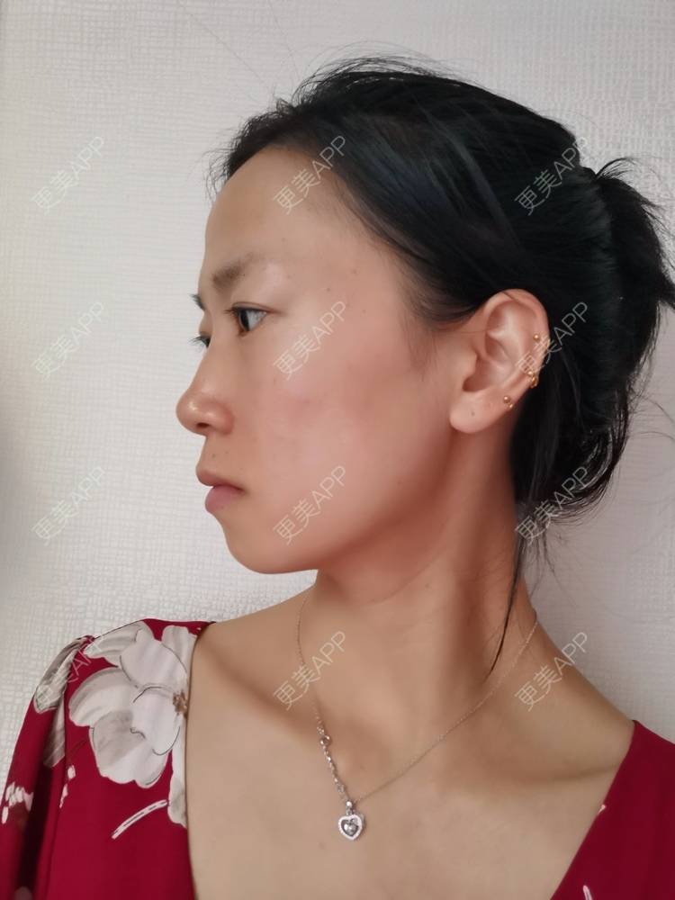 更美 - 更美用户y1zfD0qgXq的玻尿酸苹果肌经验 | 玻尿酸苹果肌 | 抚州