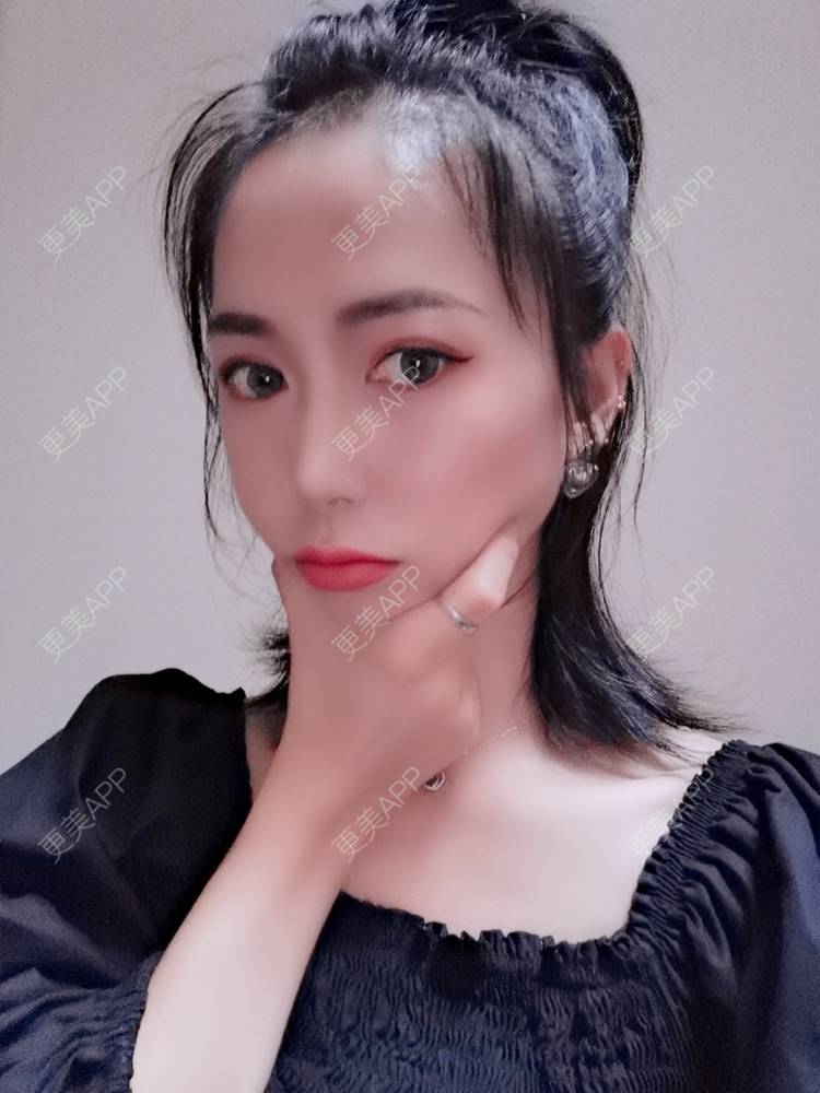 更美 - 更美用户y1zfD0qgXq的玻尿酸苹果肌经验 | 玻尿酸苹果肌 | 抚州