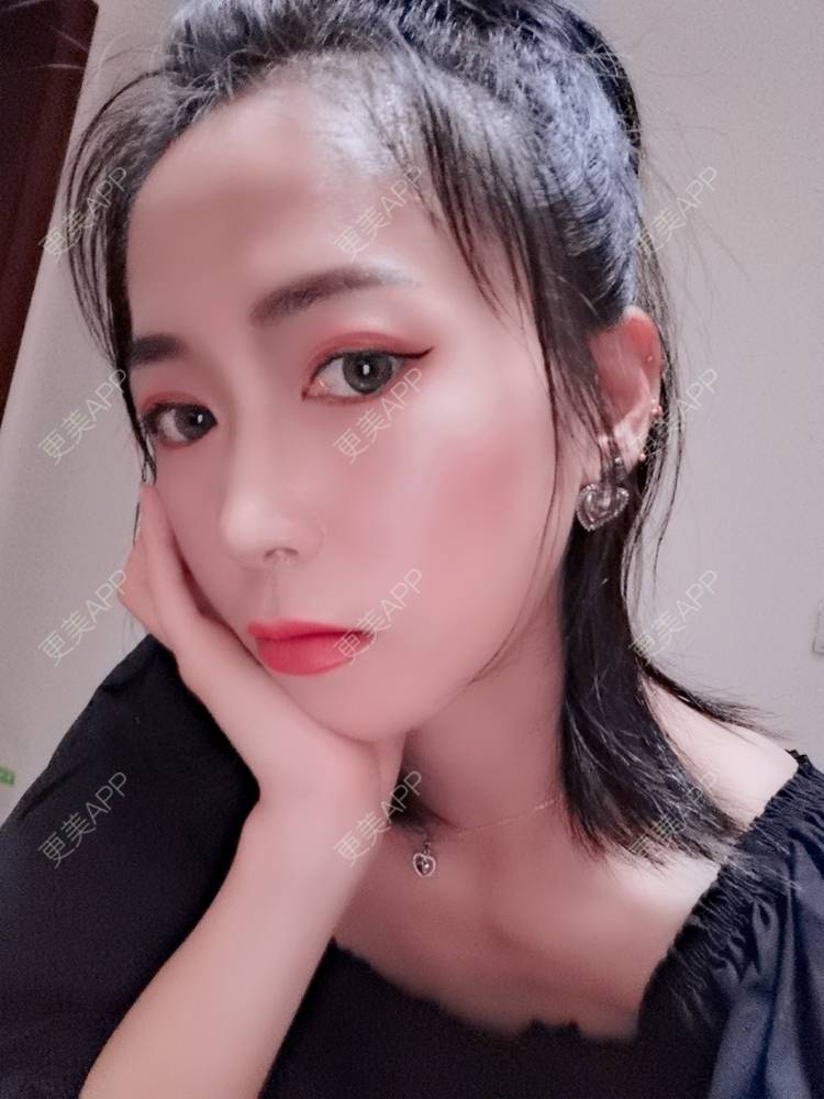更美 - 更美用户y1zfD0qgXq的玻尿酸苹果肌经验 | 玻尿酸苹果肌 | 抚州