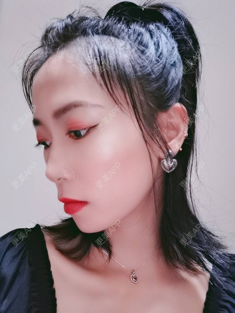 更美 - 更美用户y1zfD0qgXq的玻尿酸苹果肌经验 | 玻尿酸苹果肌 | 抚州