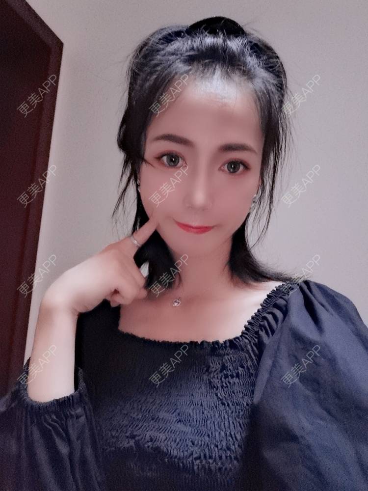更美 - 更美用户y1zfD0qgXq的玻尿酸苹果肌经验 | 玻尿酸苹果肌 | 抚州