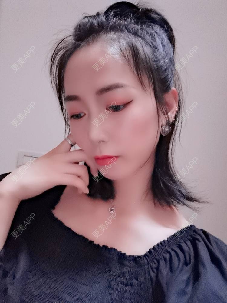 更美 - 更美用户y1zfD0qgXq的玻尿酸苹果肌经验 | 玻尿酸苹果肌 | 抚州