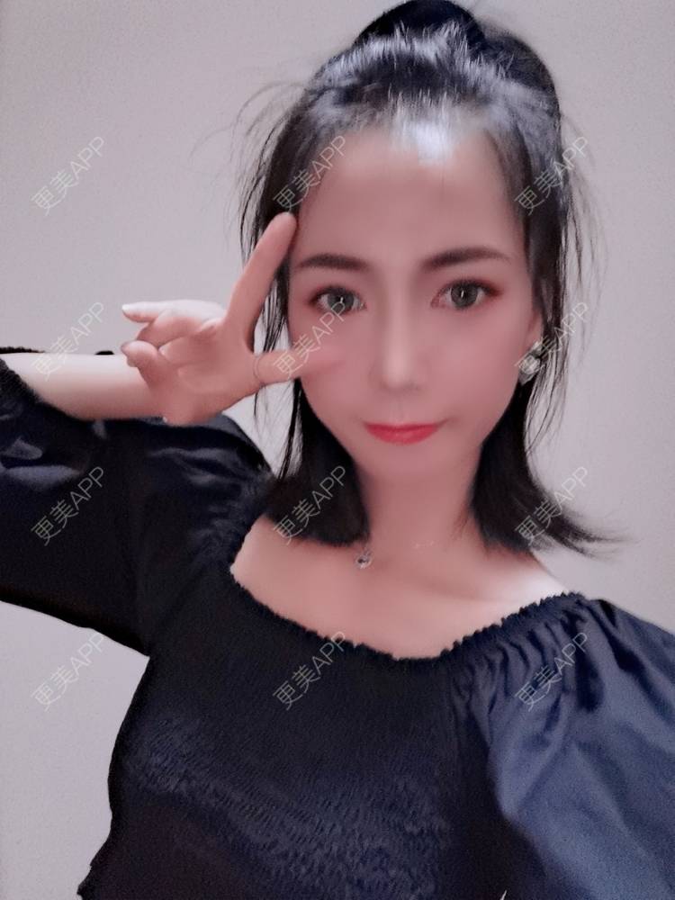 更美 - 更美用户y1zfD0qgXq的玻尿酸苹果肌经验 | 玻尿酸苹果肌 | 抚州