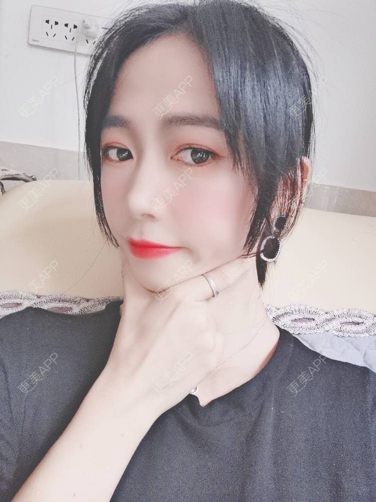 更美 - 更美用户y1zfD0qgXq的玻尿酸苹果肌经验 | 玻尿酸苹果肌 | 抚州