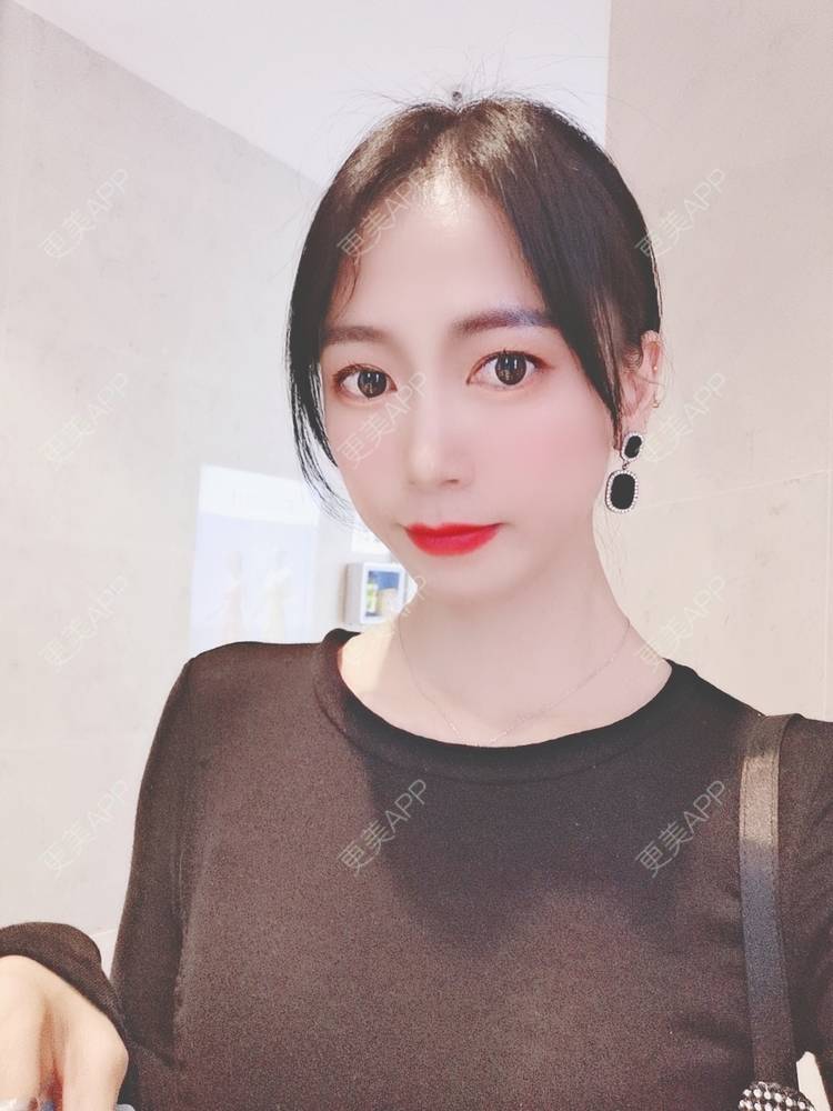 更美 - 更美用户y1zfD0qgXq的玻尿酸苹果肌经验 | 玻尿酸苹果肌 | 抚州