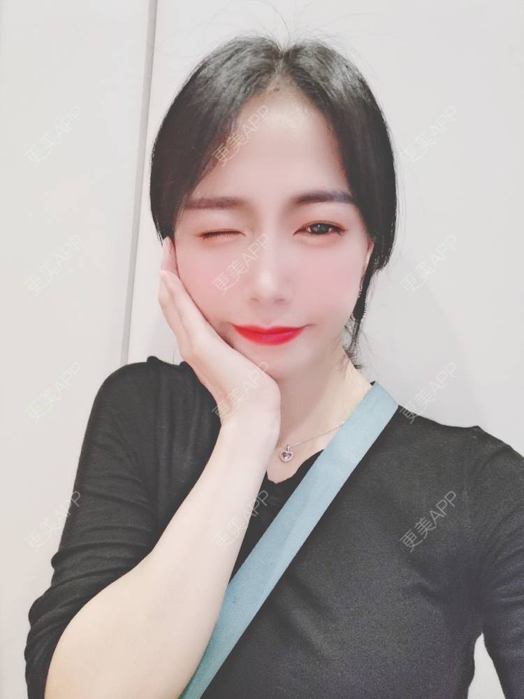 更美 - 更美用户y1zfD0qgXq的玻尿酸苹果肌经验 | 玻尿酸苹果肌 | 抚州