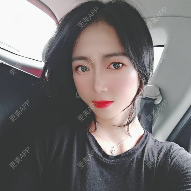 更美 - 更美用户y1zfD0qgXq的玻尿酸苹果肌经验 | 玻尿酸苹果肌 | 抚州