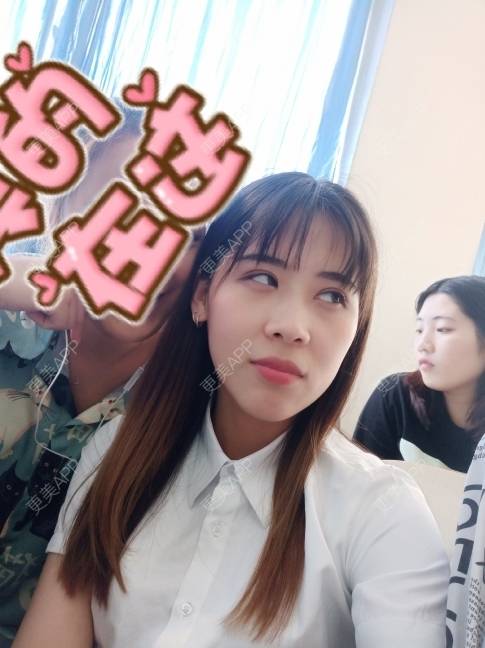 更美 - 更美用户YXs5bAlKu4的全切双眼皮经验 | 全切双眼皮 | 开内眼角 | 本溪 | 眼部多项