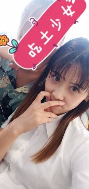 更美 - 更美用户YXs5bAlKu4的全切双眼皮经验 | 全切双眼皮 | 开内眼角 | 本溪 | 眼部多项