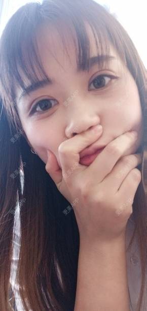 更美 - 更美用户YXs5bAlKu4的全切双眼皮经验 | 全切双眼皮 | 开内眼角 | 本溪 | 眼部多项