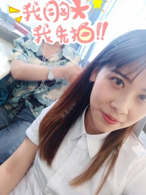 更美 - 更美用户YXs5bAlKu4的全切双眼皮经验 | 全切双眼皮 | 开内眼角 | 本溪 | 眼部多项