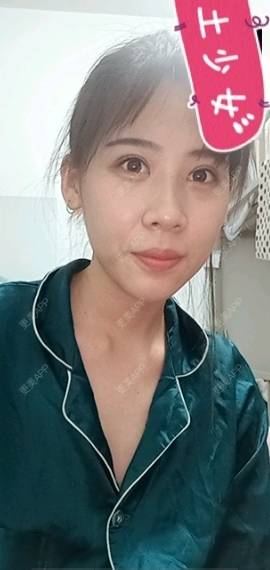 更美 - 更美用户YXs5bAlKu4的全切双眼皮经验 | 全切双眼皮 | 开内眼角 | 本溪 | 眼部多项