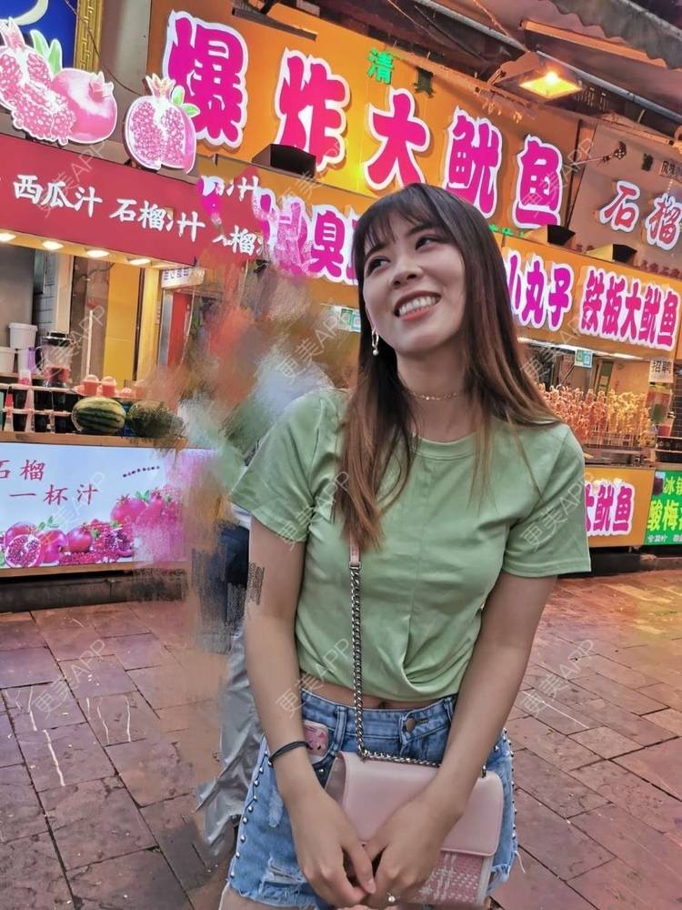 更美 - 更美用户YXs5bAlKu4的全切双眼皮经验 | 全切双眼皮 | 开内眼角 | 本溪 | 眼部多项