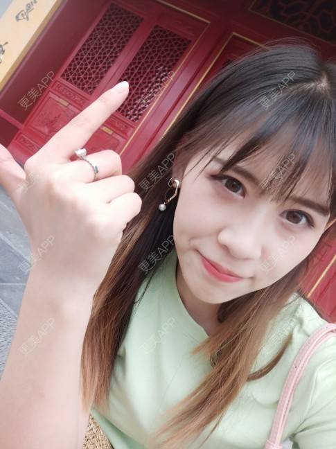 更美 - 更美用户YXs5bAlKu4的全切双眼皮经验 | 全切双眼皮 | 开内眼角 | 眼部多项