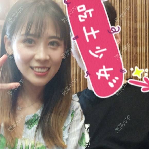 更美 - 更美用户YXs5bAlKu4的全切双眼皮经验 | 全切双眼皮 | 开内眼角 | 本溪 | 眼部多项