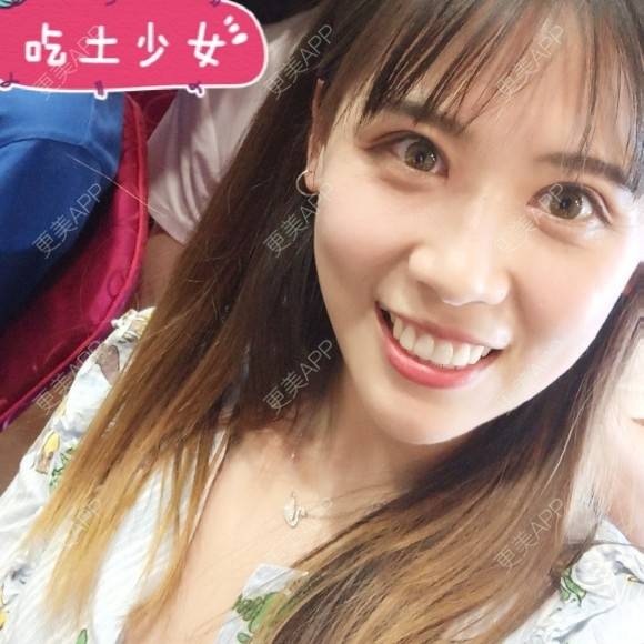 更美 - 更美用户YXs5bAlKu4的全切双眼皮经验 | 全切双眼皮 | 开内眼角 | 本溪 | 眼部多项