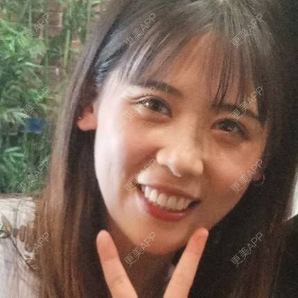 更美 - 更美用户YXs5bAlKu4的全切双眼皮经验 | 全切双眼皮 | 开内眼角 | 本溪 | 眼部多项