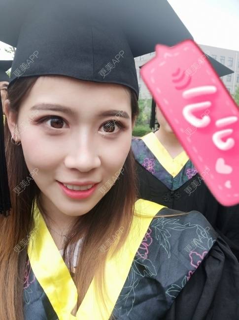 更美 - 更美用户YXs5bAlKu4的全切双眼皮经验 | 全切双眼皮 | 开内眼角 | 本溪 | 眼部多项