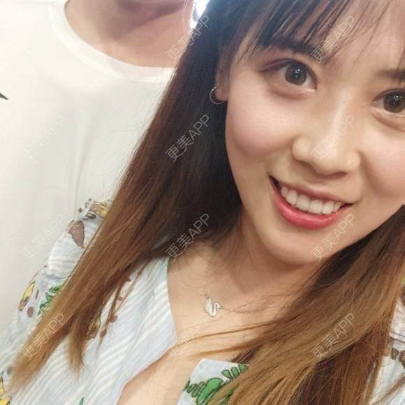 更美 - 更美用户YXs5bAlKu4的全切双眼皮经验 | 全切双眼皮 | 开内眼角 | 本溪 | 眼部多项