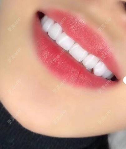 我怎么吃不饱03牙齿瓷贴面效果图_更美