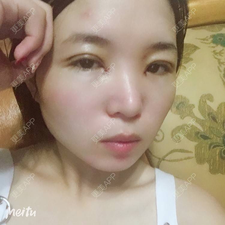 更美 - 更美用户6d6gGsAMox的双眼皮经验 | 双眼皮 | 石家庄