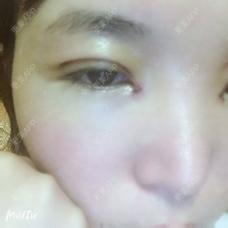 更美 - 更美用户6d6gGsAMox的双眼皮经验 | 双眼皮 | 石家庄