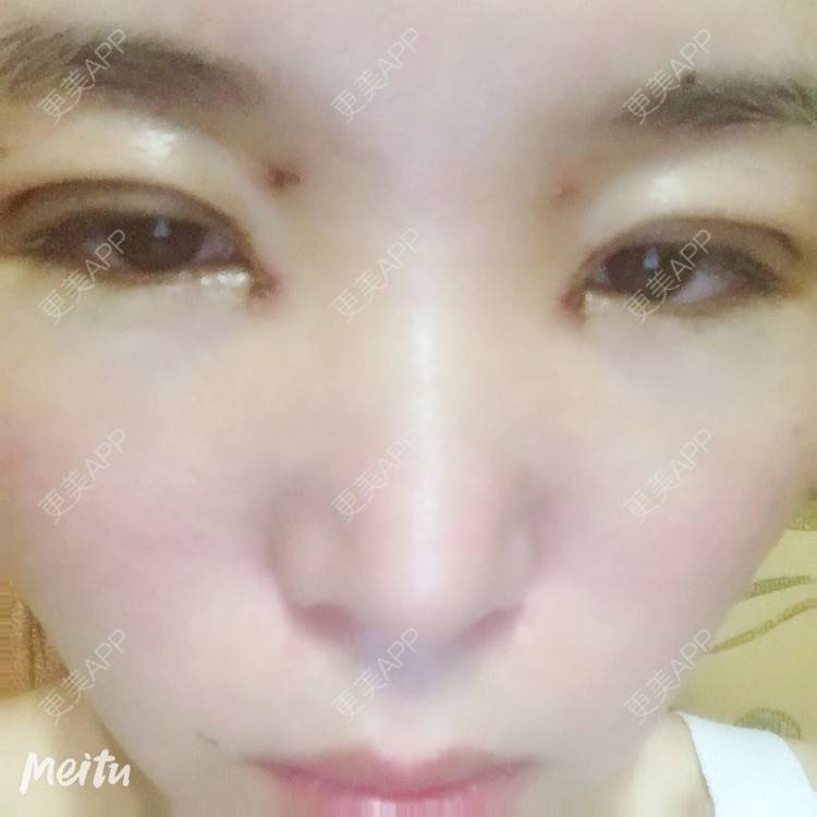 更美 - 更美用户6d6gGsAMox的双眼皮经验 | 双眼皮 | 石家庄