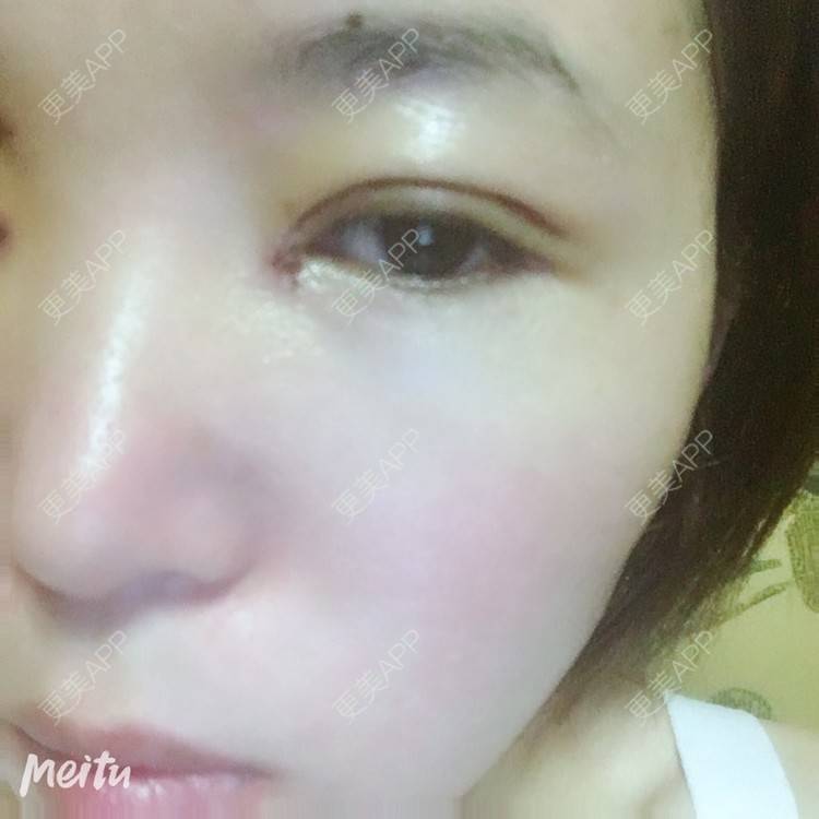 更美 - 更美用户6d6gGsAMox的双眼皮经验 | 双眼皮 | 石家庄