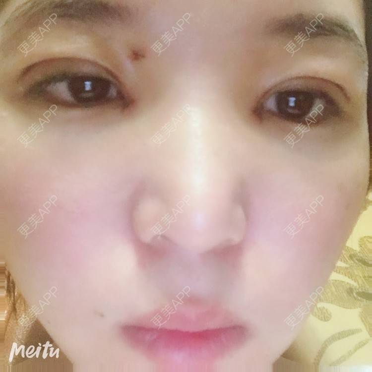 更美 - 更美用户6d6gGsAMox的双眼皮经验 | 双眼皮 | 石家庄