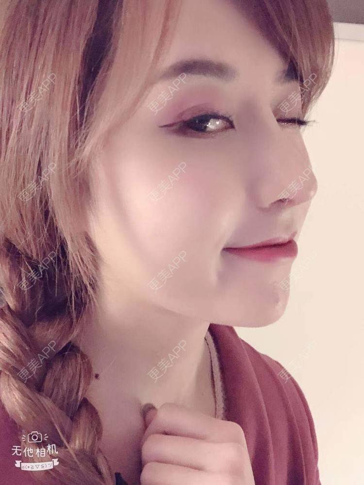 更美用户tazyddpme0的肋软骨隆鼻日记