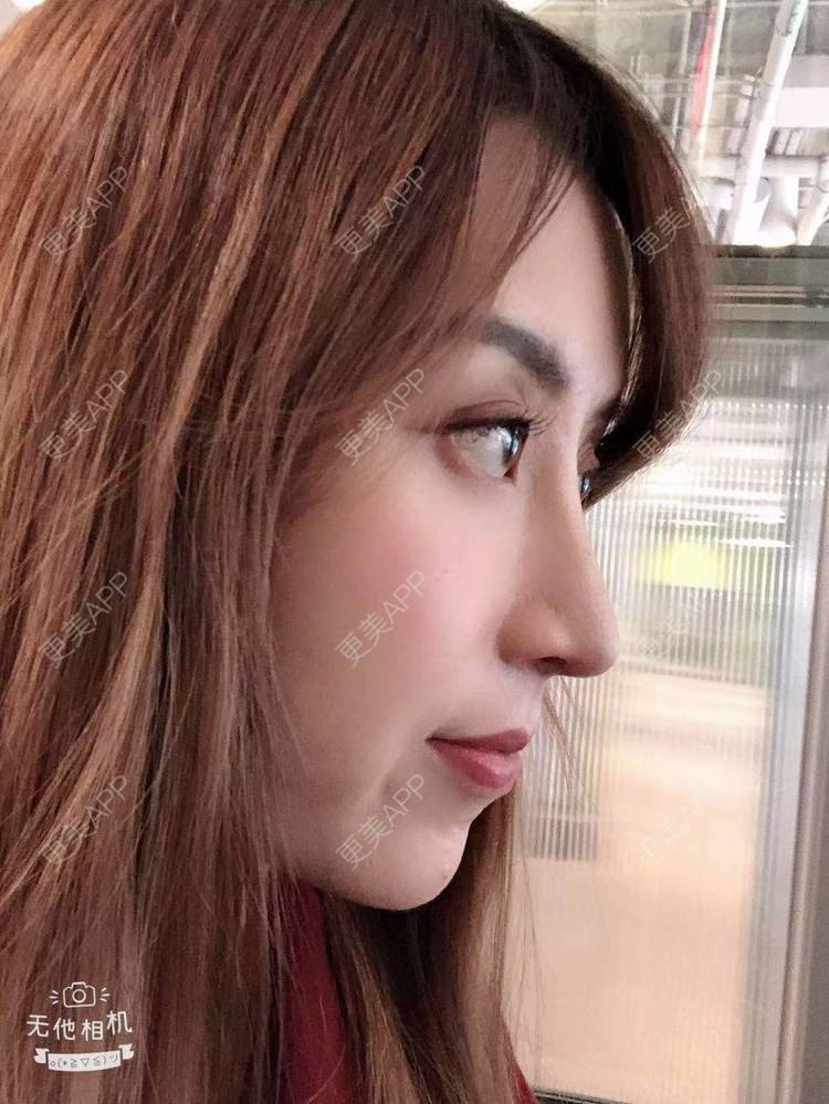 更美用户tazyddpme0的肋软骨隆鼻日记