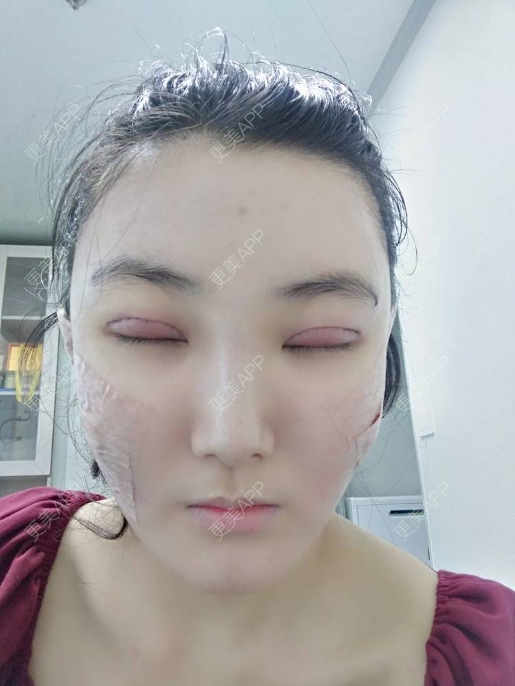 更美 - 更美用户EBRrEIgptp的颧骨颧弓经验 | 颧骨颧弓 | 郑州