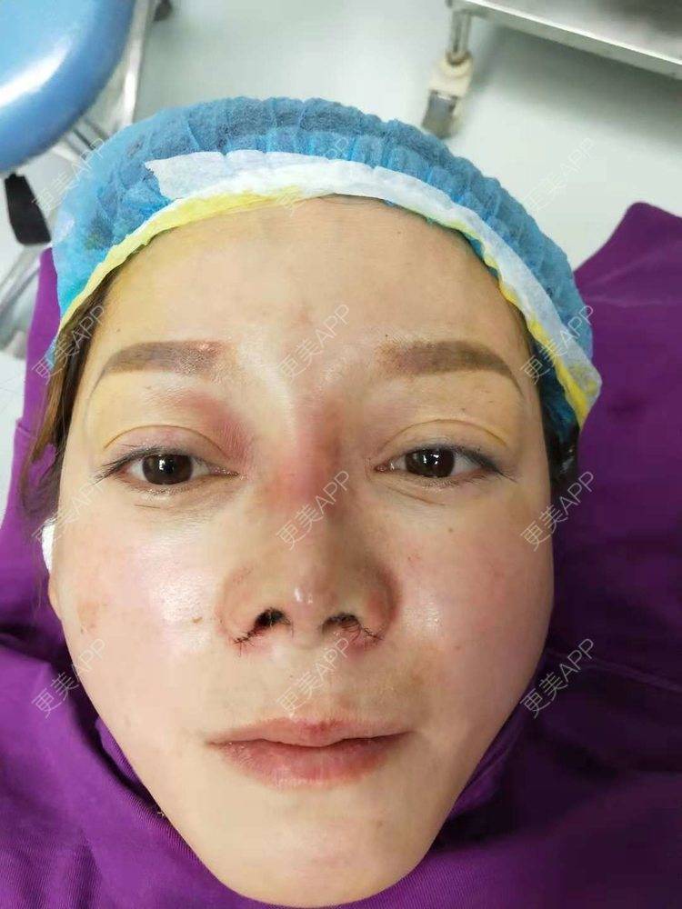 更美 - 更美用户SZI56T1Ugs的鼻部多项经验 | 耳软骨隆鼻 | 隆胸假体取出 | 鼻部多项 | 鼻部多项 | 苏州