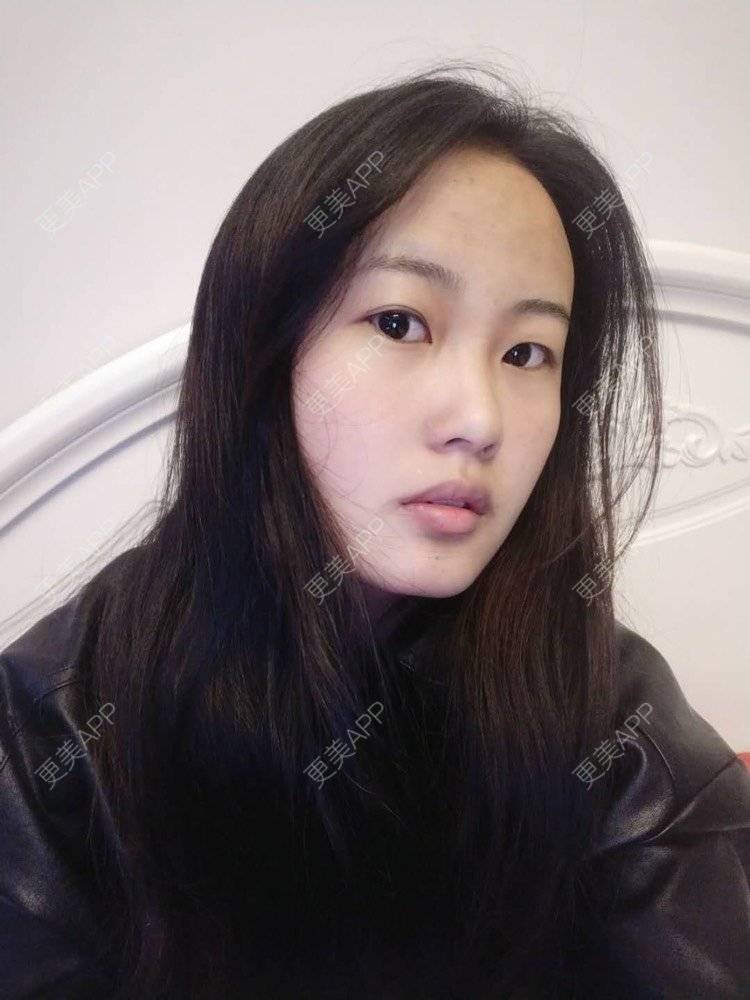 更美 - 云南华美美莱美容医院的双眼皮经验 | 双眼皮 | 昆明 | 眼部多项