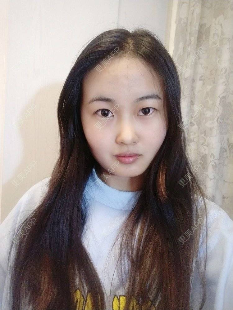 更美 - 云南华美美莱美容医院的双眼皮经验 | 双眼皮 | 昆明 | 眼部多项
