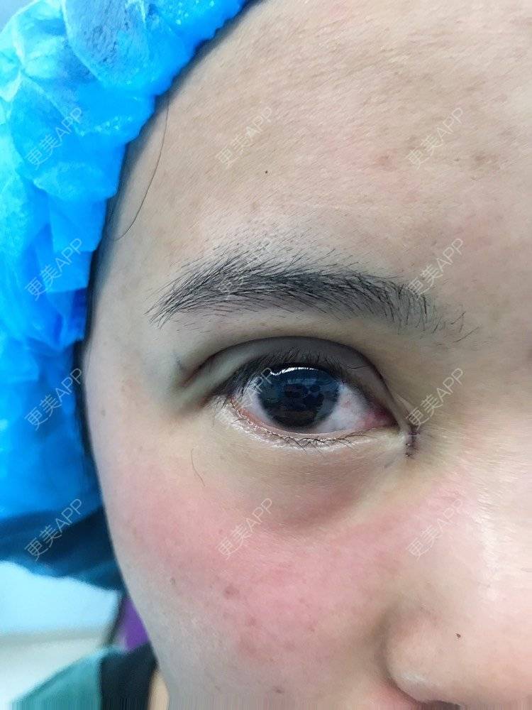 更美 - 云南华美美莱美容医院的双眼皮经验 | 双眼皮 | 昆明 | 眼部多项