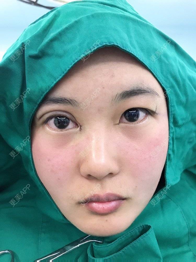 更美 - 云南华美美莱美容医院的双眼皮经验 | 双眼皮 | 昆明 | 眼部多项