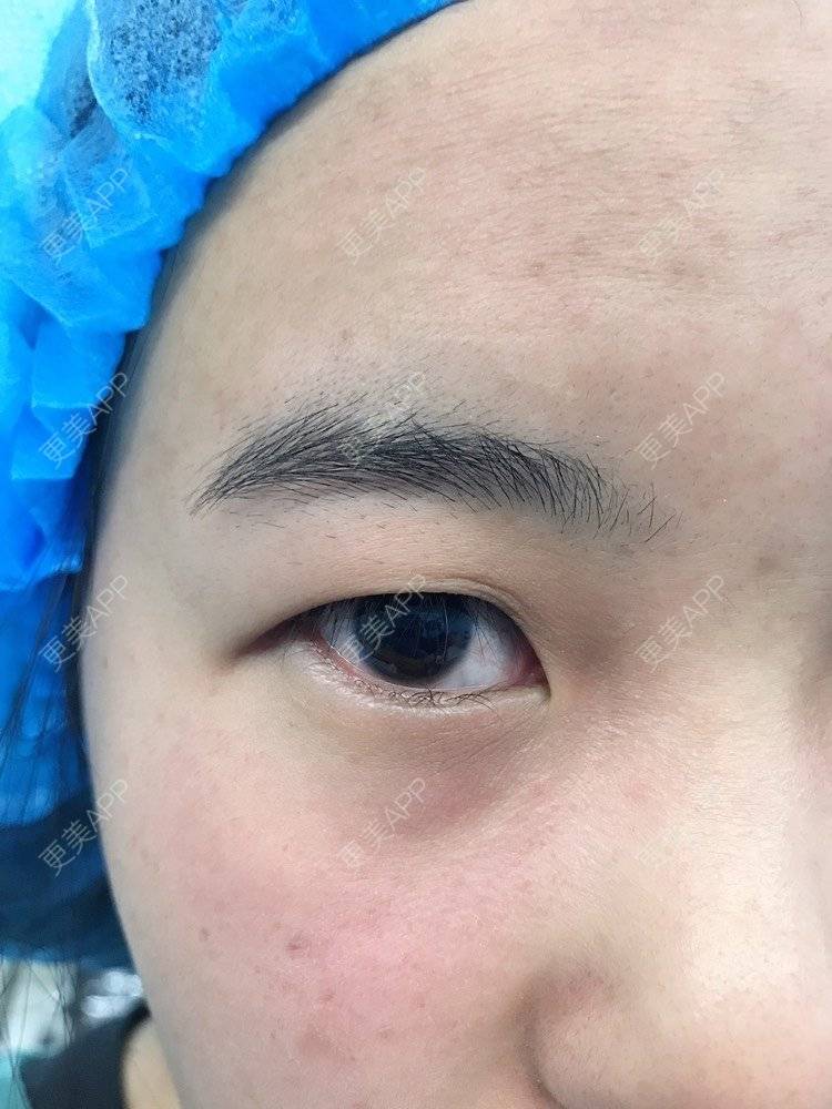 更美 - 云南华美美莱美容医院的双眼皮经验 | 双眼皮 | 昆明 | 眼部多项