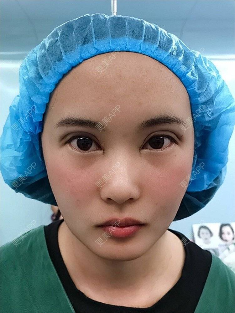 更美 - 云南华美美莱美容医院的双眼皮经验 | 双眼皮 | 昆明 | 眼部多项