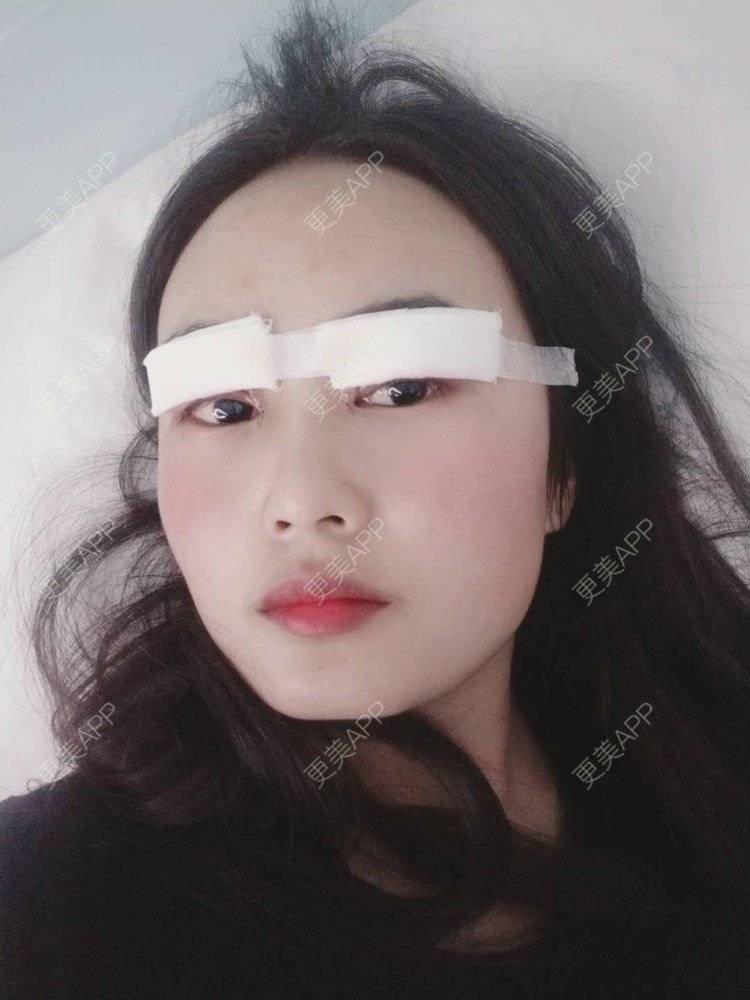 更美 - 云南华美美莱美容医院的双眼皮经验 | 双眼皮 | 昆明 | 眼部多项