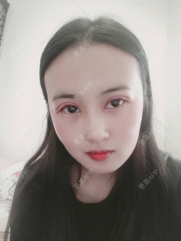 更美 - 云南华美美莱美容医院的双眼皮经验 | 双眼皮 | 昆明 | 眼部多项