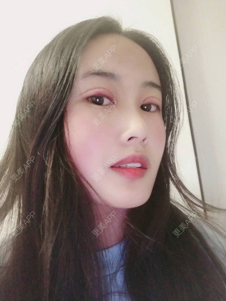 更美 - 云南华美美莱美容医院的双眼皮经验 | 双眼皮 | 昆明 | 眼部多项