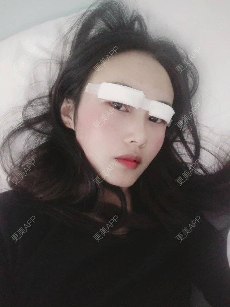 更美 - 云南华美美莱美容医院的双眼皮经验 | 双眼皮 | 昆明 | 眼部多项