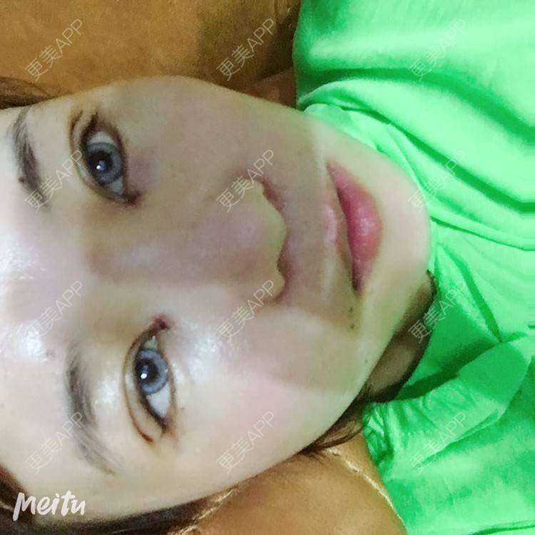 更美 - 更美用户6d6gGsAMox的双眼皮经验 | 双眼皮 | 石家庄