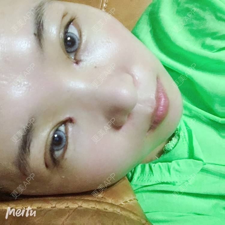 更美 - 更美用户6d6gGsAMox的双眼皮经验 | 双眼皮 | 石家庄