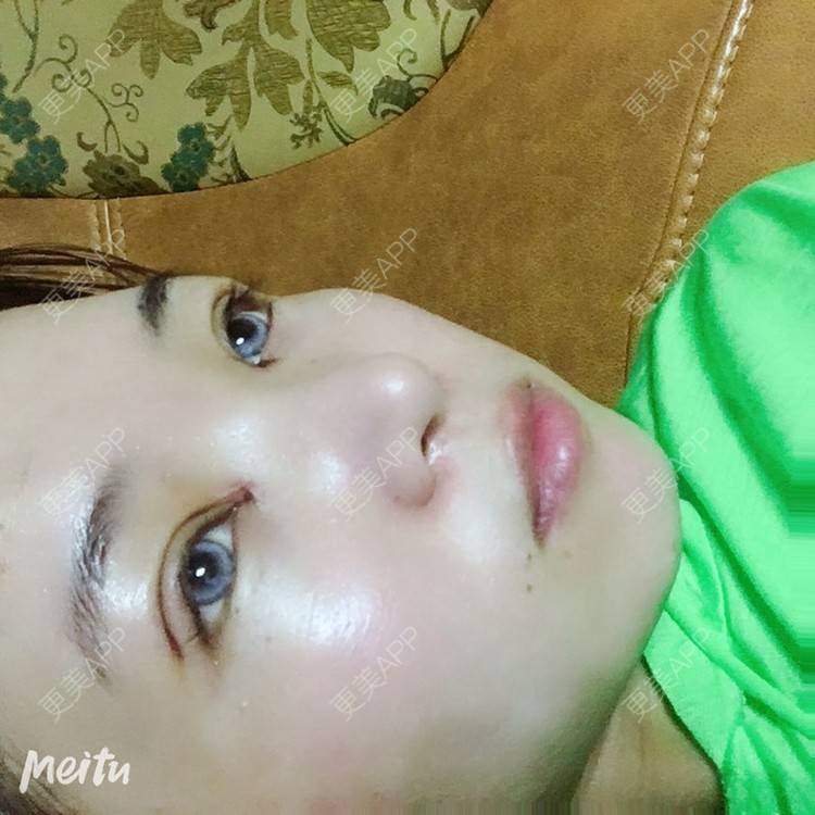 更美 - 更美用户6d6gGsAMox的双眼皮经验 | 双眼皮 | 石家庄