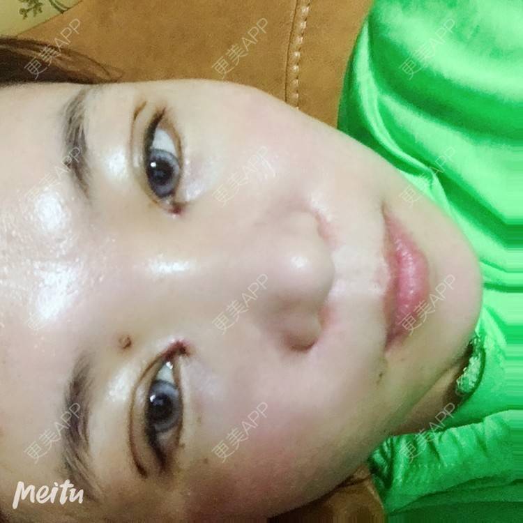 更美 - 更美用户6d6gGsAMox的双眼皮经验 | 双眼皮 | 石家庄